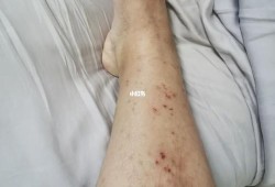 孕晚期孕妇湿疹手脚都有，奇痒无比，怎么办呀,孕期湿疹怎么止痒最快