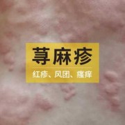 孕期起荨麻疹（孕早期得了荨麻疹怎么办）
