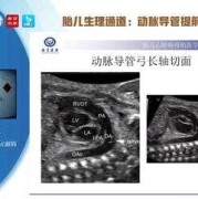 胎儿动脉导管（胎儿动脉导管走形迂曲是什么意思）