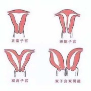 不完全纵隔子宫对胎儿会有什么影响吗?会造成羊水过少吗,纵隔子宫对胎儿的影响大吗