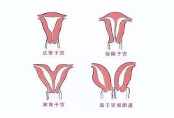 不完全纵隔子宫对胎儿会有什么影响吗?会造成羊水过少吗,纵隔子宫对胎儿的影响大吗