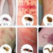 孕期丘疹性荨麻疹（丘疹型荨麻疹该怎样治疗）