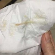 怀孕中期白带有血丝,孕期中期出血正常吗