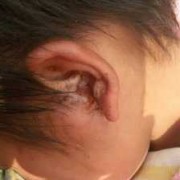 孕期耳朵流脓（孕期耳朵流脓不痛对胎儿有没有问题）