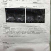 怀孕四十三天B超检查胎囊周围有液性暗区，该怎么办,孕期四周为一个月吗