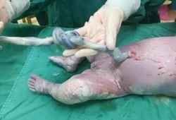请问怀孕38周脐带绕颈一周还能绕出来吗,胎儿绕颈一周能顺产吗视频