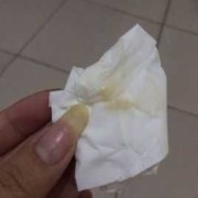 怀孕后白带呈褐色怎么回事,孕期 棕色分泌物