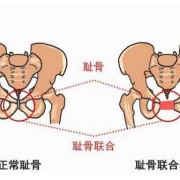 孕期骨盆痛怎么办,孕期骨盆痛位置图