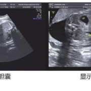 胎儿未见胆囊临床经验（胎儿未见胆囊临床经验）