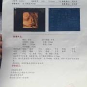 怀孕19周做2维彩超说胎儿胃泡显示不清。怎么办,胎儿胃泡是什么回声