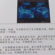 胎儿体重怎么计算最准？孕晚期时候了，怎样估算准一些呢,b超怎么算胎儿体重的公式