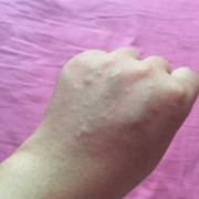 孕期皮肤发痒（孕期皮肤发痒怎么回事）