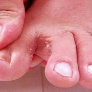 孕期脚气脚痒怎么办啊,孕期脚趾头痒怎么回事