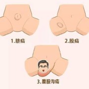 孕期疝气怎么办（疝气是怎么引起的孕妇）