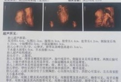 孕期可以做两次四维吗（孕期可以做两次四维吗）