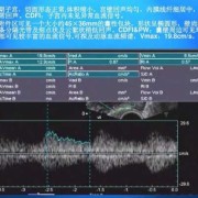 子宫肌瘤中CDFI:周边可见带状血流信号,孕妇宫腔内带状分隔