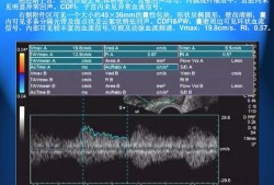 子宫肌瘤中CDFI:周边可见带状血流信号,孕妇宫腔内带状分隔