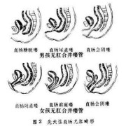 胎儿肛门闭锁孕妇有什么症状,胎儿无肛门是什么原因引起的