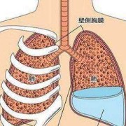 肺部积水怎么处理,胎儿肺部积液严重吗