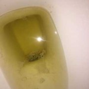 孕期尿路感染了对宝宝有影响不（孕妇尿完又想尿,下面老是有尿意）