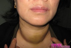 胎儿甲亢（胎儿甲亢的症状及危害）