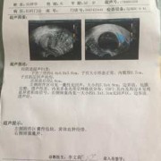 怀孕了才发现有卵巢囊肿严重吗,怀孕卵巢囊肿会影响胎儿吗