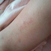 孕期腿痒（孕期腿痒怎么回事）