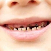 小孩子有龋齿会影响换牙吗,龋齿细菌对胎儿影响大吗