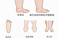 胎儿脚在右侧是男是女（一岁宝宝走路两只脚不一样）