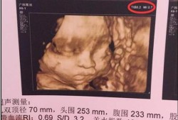 hl指胎儿的什么意思（四维彩超hl是什么意思）