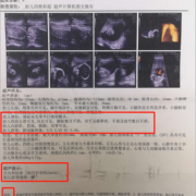 胎儿检测畸形（胎儿检测畸形怎么办）