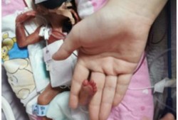 24周的胎儿能活下去吗,24周胎儿生殖图片