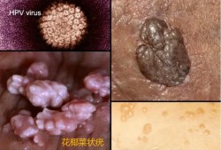尖锐湿庞对胎儿的影响（我得了尖锐湿疣，可以要孩子吗）