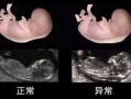 孕妇nf检查是什么意思,胎儿NF是什么意思
