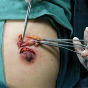 有乳腺纤维瘤可以怀孕吗,孕期纤维瘤会长大吗
