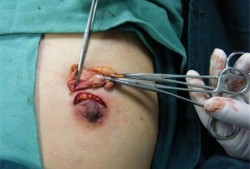 有乳腺纤维瘤可以怀孕吗,孕期纤维瘤会长大吗
