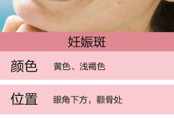 孕期妊辰斑（孕期妊辰斑怎么去掉）