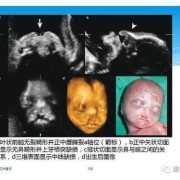 胎儿上唇裂（胎儿上唇裂伴腭裂原因）