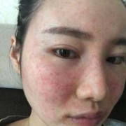 脸部色素沉着怎么办,孕期色素沉着怎么办