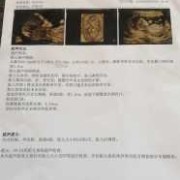 胎儿nt增厚原因有什么,正常胎儿nt也会增厚吗