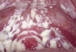 怀孕了经常得霉菌性阴道炎对胎儿有影响吗,怀孕期间有霉菌会影响胎儿吗