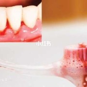 孕期牙龈出血怎么办（孕期刷牙牙龈出血怎么回事）