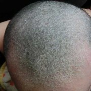 婴儿有头皮屑怎么办,胎儿头皮屑怎么去除