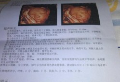 四维检测说胎儿有肾囊肿怎么办,胎儿肾核磁共振