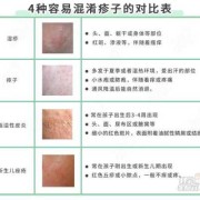 孕期湿疹很严重怎么办（孕妇得了湿疹怎么办）