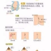 孕期肛裂（孕期肛裂）