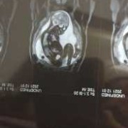 胎儿磁共振能查出什么（核磁共振有辐射吗？孕妇可以做吗）