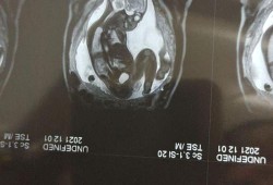 胎儿磁共振能查出什么（核磁共振有辐射吗？孕妇可以做吗）