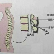 全麻衬与半麻衬的区别,半麻对胎儿的影响