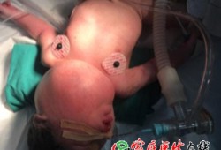 胎儿颈部淋巴管瘤（胎儿颈部淋巴管瘤严重吗）